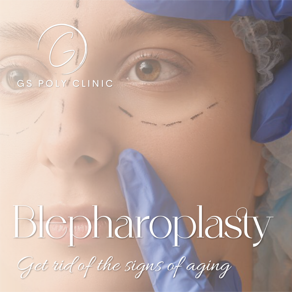 blepharoplasty