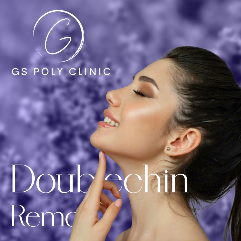 double-chin-removal