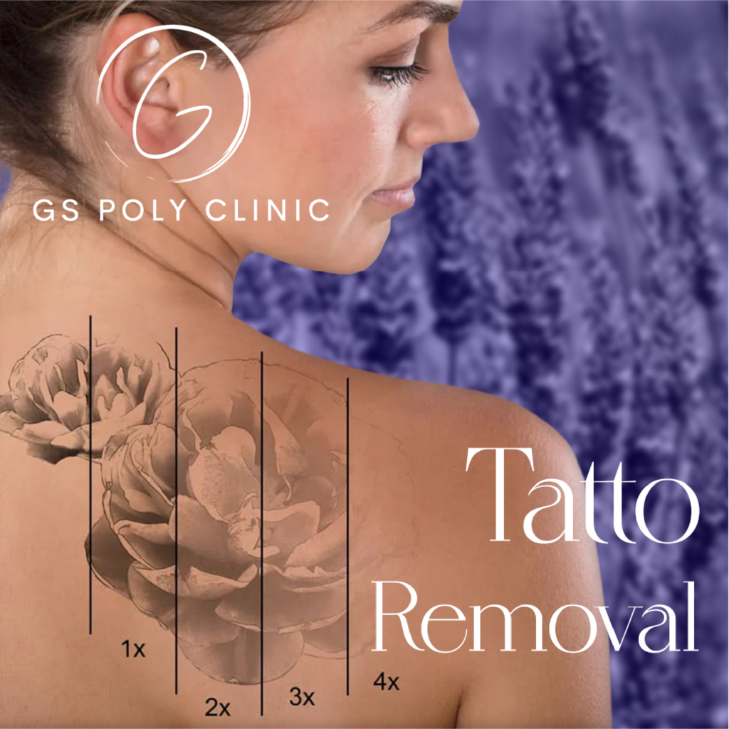 tatto-removal